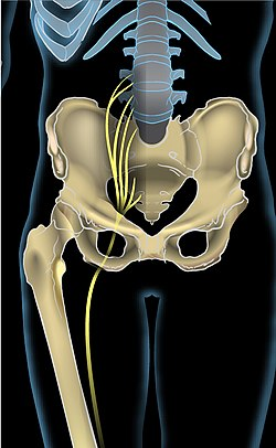 sciatica